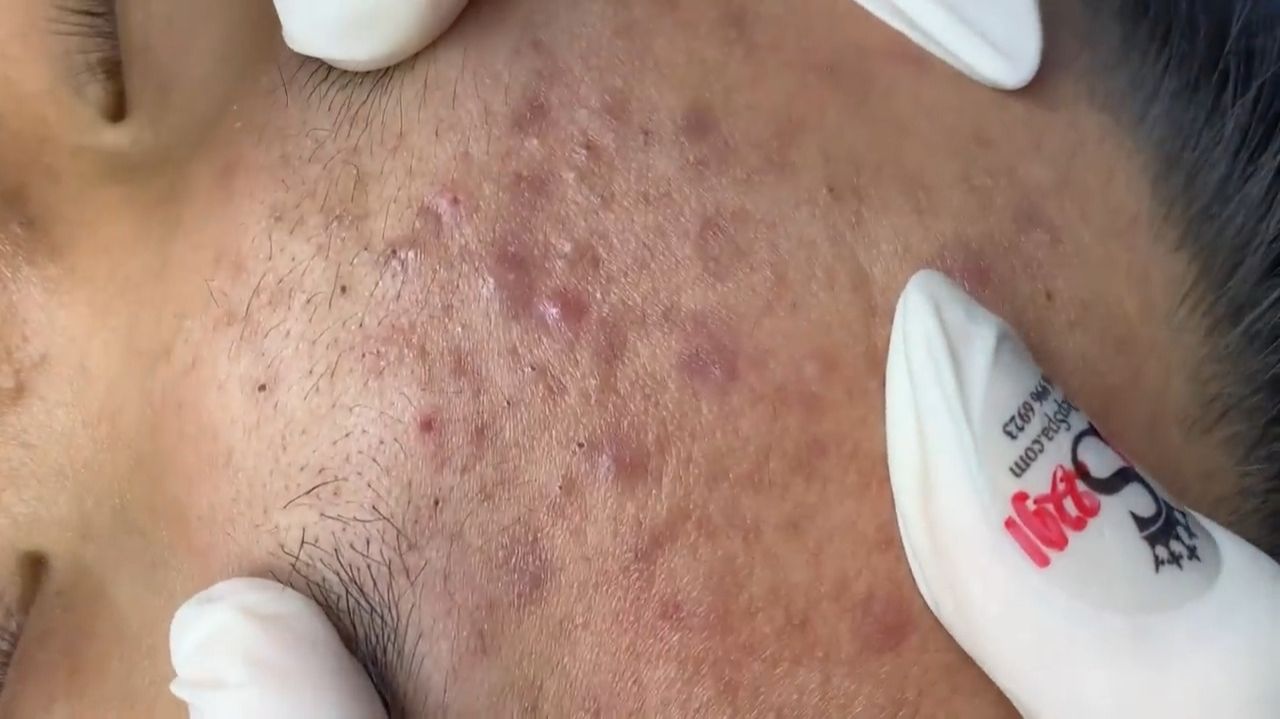 224 • Acne collection • АСМР • Relax Spa смотреть онлайн