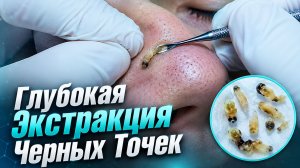 Полное очищение комедонов с нежной экстракцией внутренних угрей