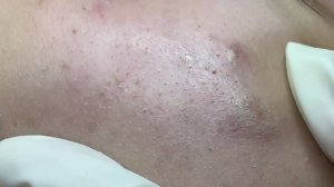 Глубокое удаление прыщей — достаем старые стержни
