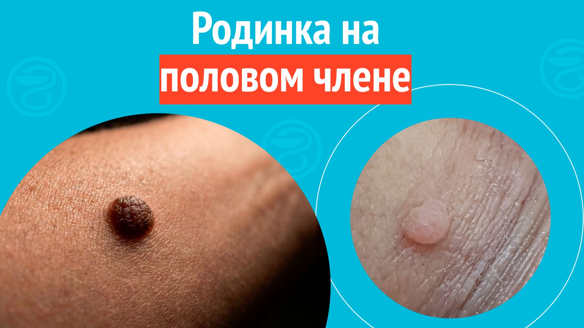 👉 Родинка на половом члене. Клинический случай № 1732 смотреть онлайн