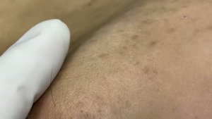 Удаление прыщей на щеках — глубокие очаги