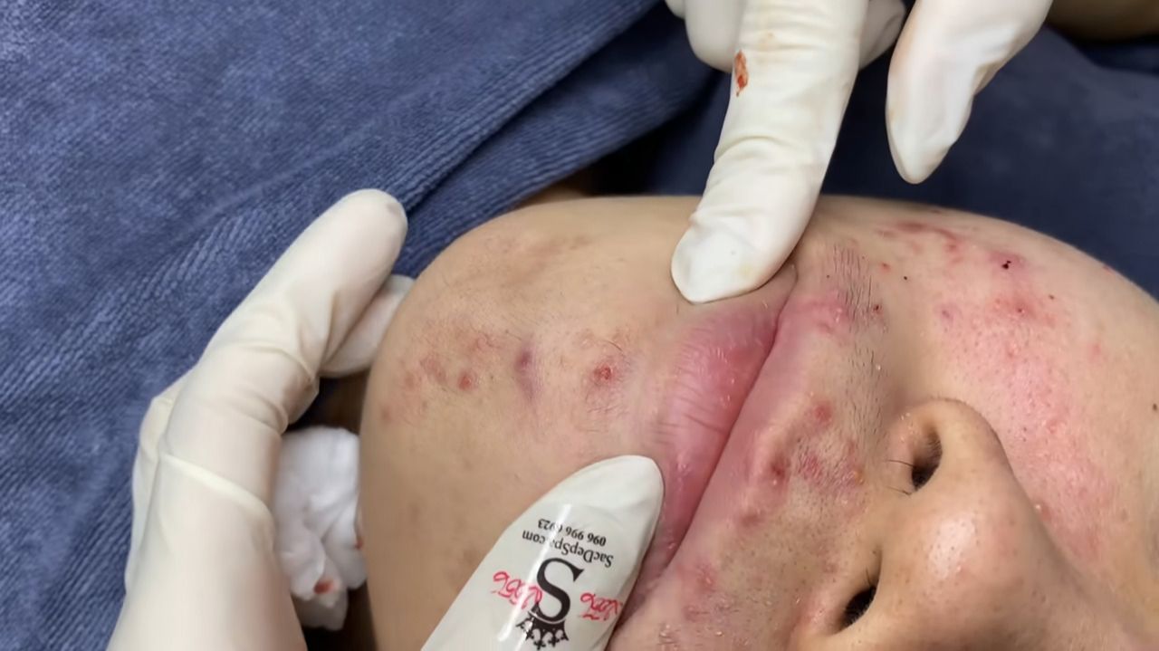 228 • Acne collection • АСМР • Relax Spa смотреть онлайн