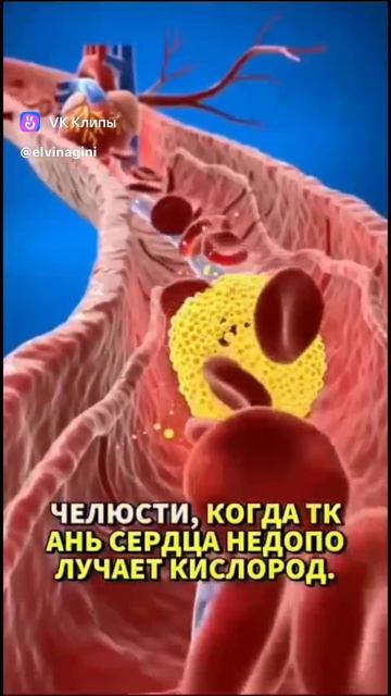 Инфаркт😠