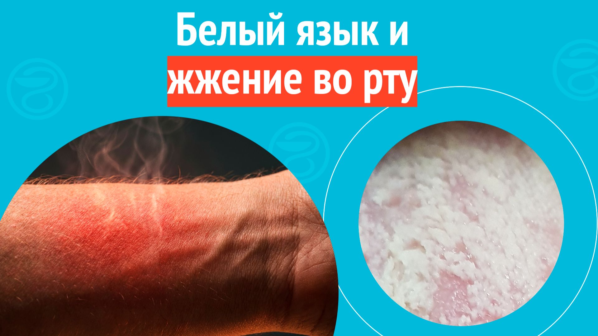 👅 Белый язык и жжение во рту. Клинический случай № 1729 смотреть онлайн