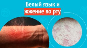 👅 Белый язык и жжение во рту. Клинический случай № 1729