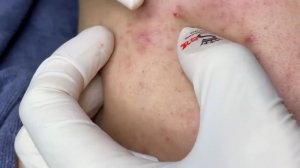 218 • Acne collection • АСМР • Relax Spa
