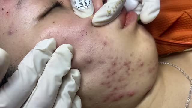 Эстетичное удаление прыщей и комедонов смотреть онлайн