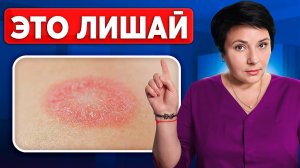Как избавиться от лишая на коже? Пошаговая инструкция