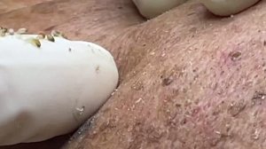 Выдавила всё: прыщи, черные точки, комедоны