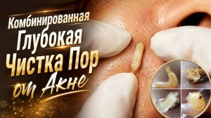 Эстетичное и мощное удаление белых комедонов с нежным уходом за кожей