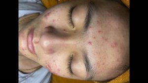 Удаление воспаленных подростковых прыщей — чистка лица