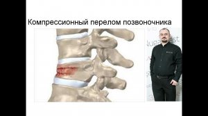Компрессионный перелом позвоночника