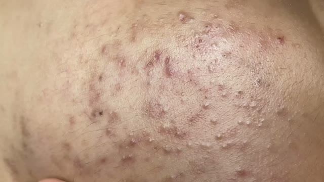 Подростковые черные точки — удаление смотреть онлайн