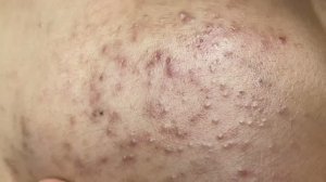 Подростковые черные точки — удаление