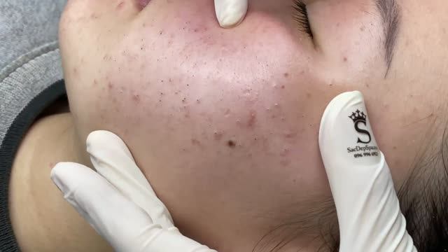 Чистка лица девушки от черных точек смотреть онлайн