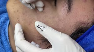 Чистка лица от подкожных черных точек — достаем плотные стержни