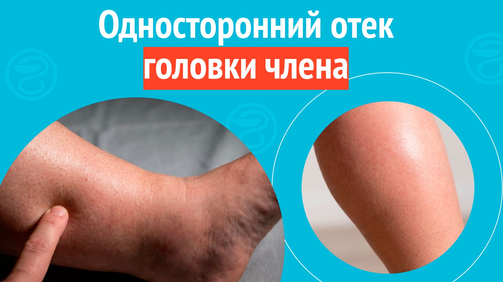 😦 Односторонний отек головки члена. Клинический случай № 1718 смотреть онлайн