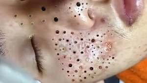 Выдавливание прыщей и удаление черных точек. Новое видео