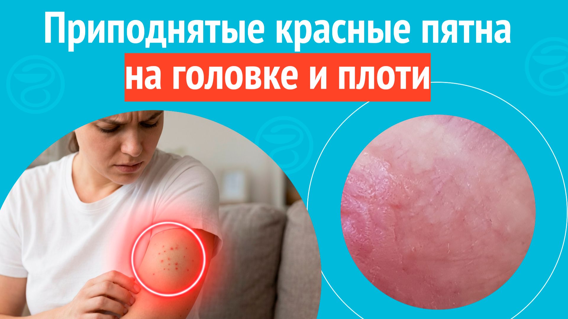 😡 Приподнятые красные пятна на головке и плоти. Клинический случай № 1725 смотреть онлайн