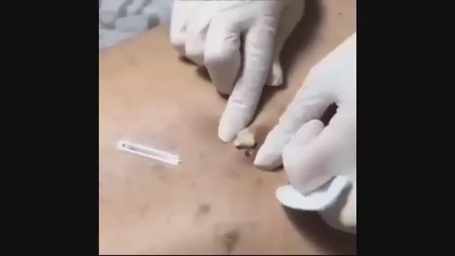 ВЫДАВЛИВАНИЕ ПРЫЩЕЙ И УГРЕЙ. СУПЕР ВИДЕО ДЛЯ РАССЛАБЛЕНИЯ! смотреть онлайн