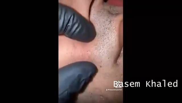 Попрощайтесь с черными точками и прыщами с помощью этой корейской техники ухода за кожей смотреть онлайн
