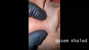 Попрощайтесь с черными точками и прыщами с помощью этой корейской техники ухода за кожей