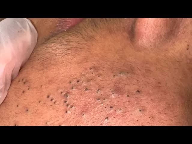 Удаление черных точек на лице | Корейский уход за кожей для чистых пор смотреть онлайн