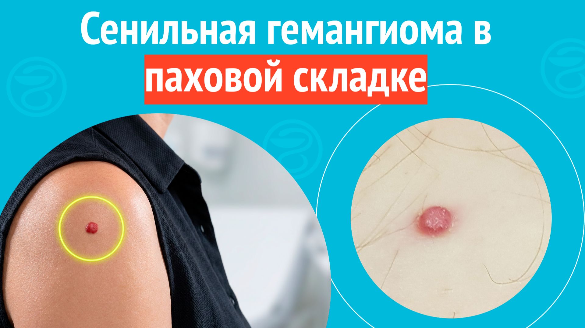 ➡️ Сенильная гемангиома в паховой складке. Клинический случай № 1722 смотреть онлайн
