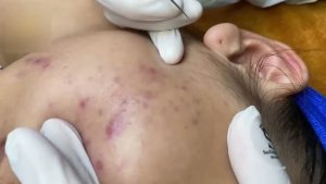 Ликвидация гормональных прыщей и акне