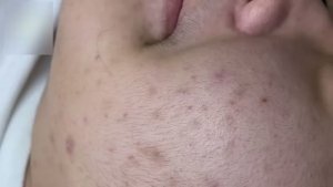 Избавление от прыщей и акне на лице
