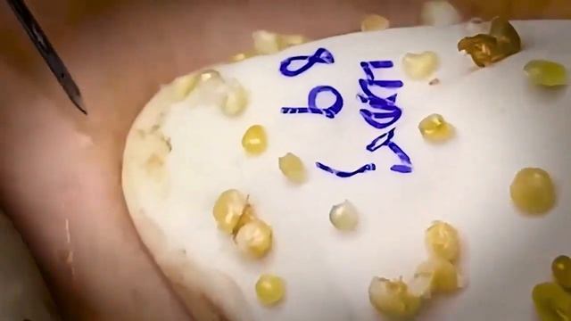 ВЫДАВЛИВАЕТ ПРЫЩИ И УГРИ. СОЧНОЕ РЕЛАКС ВИДЕО смотреть онлайн