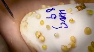 ВЫДАВЛИВАЕТ ПРЫЩИ И УГРИ. СОЧНОЕ РЕЛАКС ВИДЕО