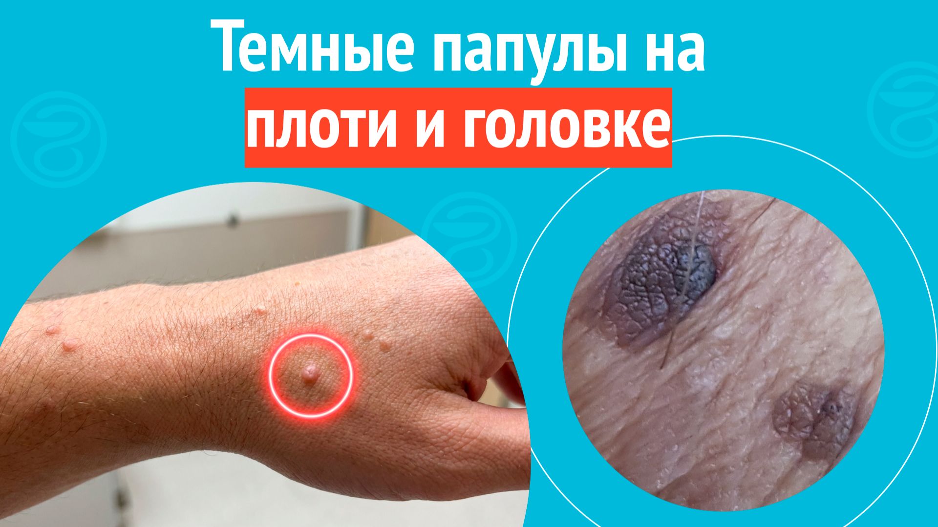 👉 Темные папулы на плоти и головке. Клинический случай № 1726 смотреть онлайн