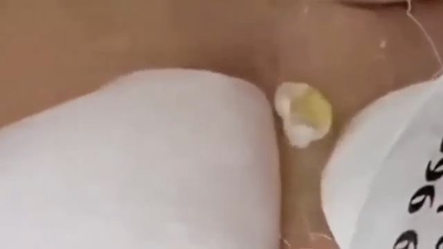 Экстремальное удаление черных точек: расслабляющее видео #930 смотреть онлайн