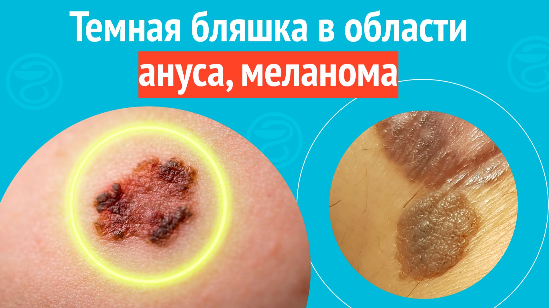 😟 Темная бляшка в области ануса, меланома. Клинический случай № 1719 смотреть онлайн