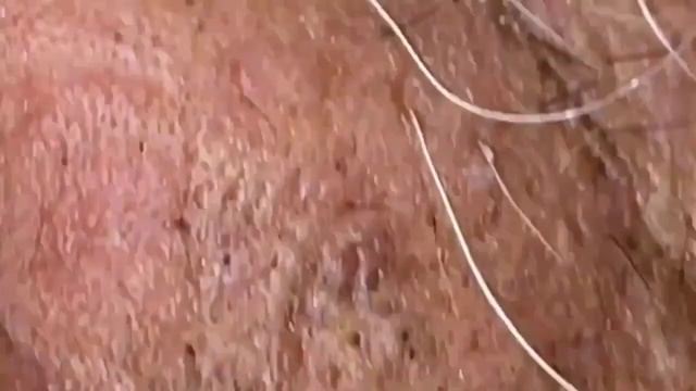 ВЫДАВЛИВАЕТ ПРЫЩИ И УГРИ. СОЧНОЕ РЕЛАКС ВИДЕО смотреть онлайн