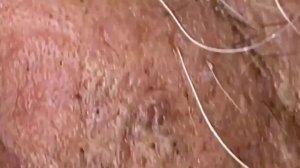 ВЫДАВЛИВАЕТ ПРЫЩИ И УГРИ. СОЧНОЕ РЕЛАКС ВИДЕО