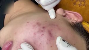 Избавление от прыщей и акне на лице в салоне