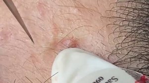 Нежное очищение лица ДЛИННОЕ ВИДЕО ВЫДАВЛИВАНИЕ ПРЫЩЕЙ