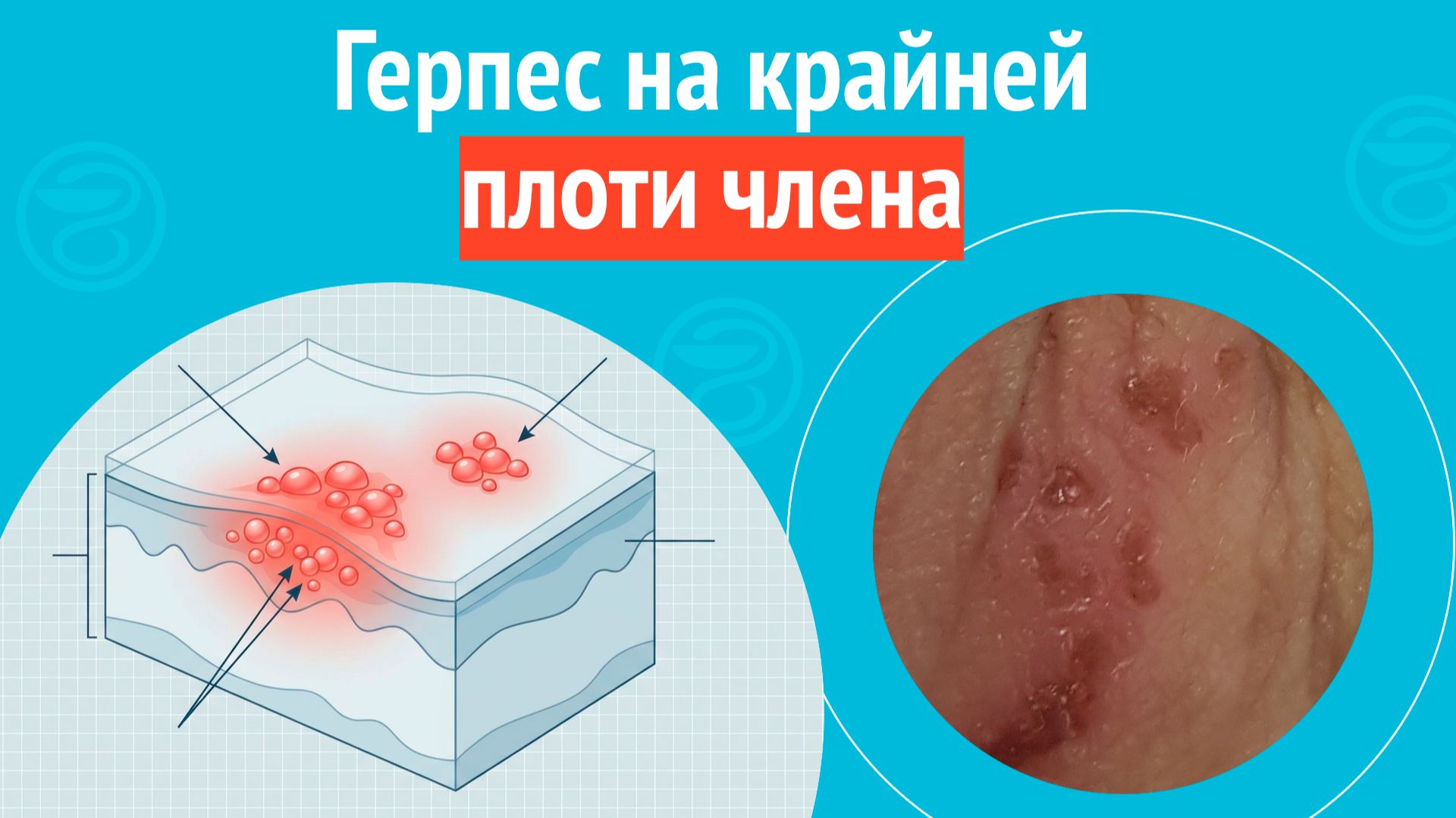 🥺 Герпес на крайней плоти члена. Клинический случай № 1723 смотреть онлайн