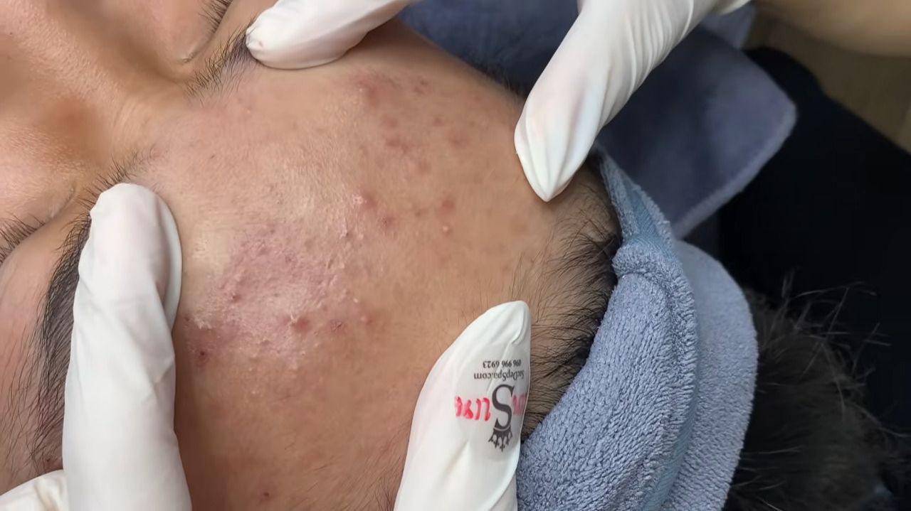 226 • Acne collection • АСМР • Relax Spa смотреть онлайн