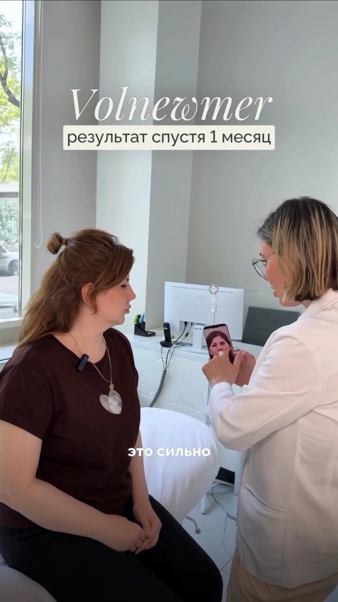 Результат процедуры спустя месяц после RF‑лифтинга на аппарате Volnewmer🤍