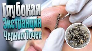 Мягкое удаление сальных нитей и интенсивная чистка забитых пор