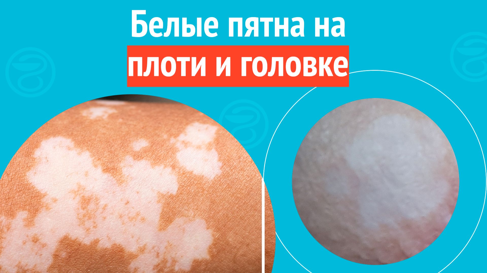 ➡️ Белые пятна на плоти и головке. Клинический случай № 1720 смотреть онлайн