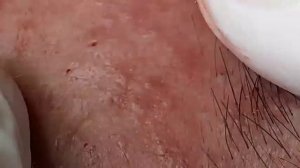 ДЛИННОЕ ВИДЕО ВЫДАВЛИВАНИЕ ПРЫЩЕЙ БОЛЬШЕ ЧАСА ДОЛГО