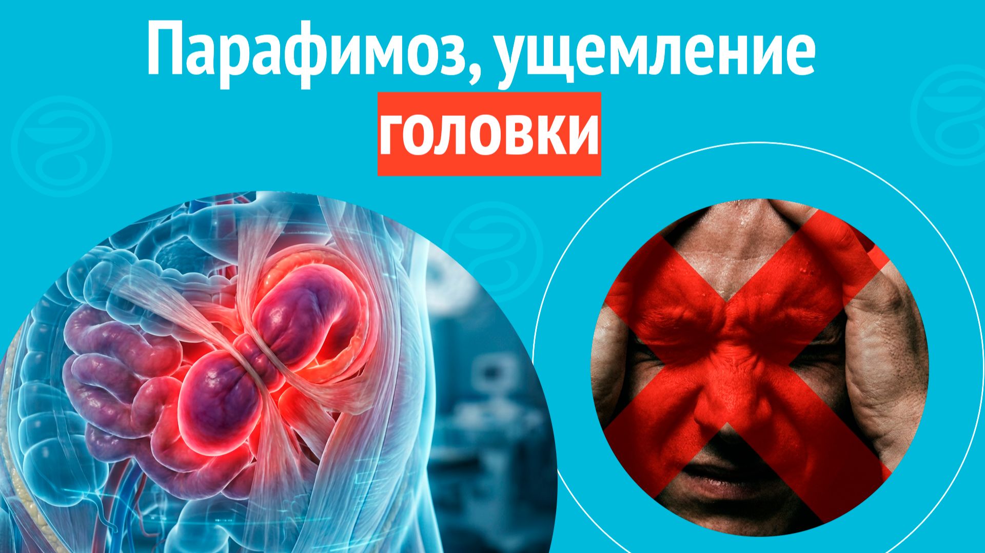 🙁 Парафимоз, ущемление головки. Клинический случай № 1724 смотреть онлайн