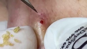 ДЛИННОЕ ВИДЕО ВЫДАВЛИВАНИЕ ПРЫЩЕЙ БОЛЬШЕ ЧАСА ДОЛГОЕ часть 33