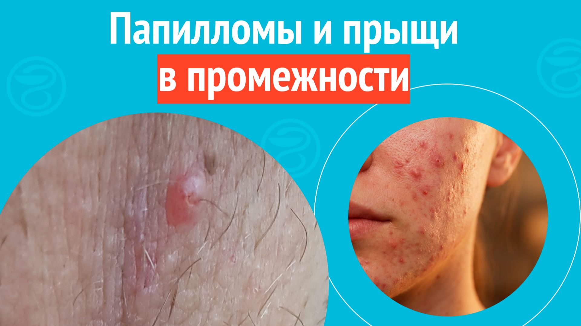 🥺 Папилломы и прыщи в промежности. Клинический случай № 1721 смотреть онлайн
