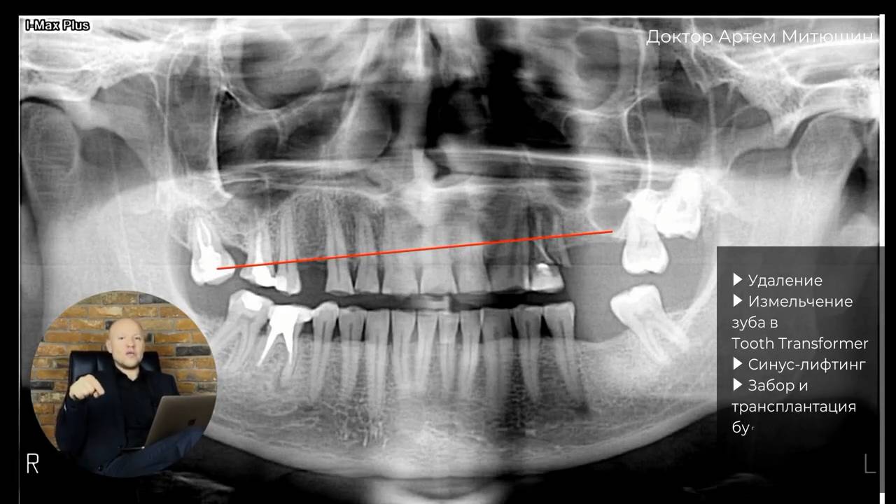 Хирургия и имплантология → Оборудование для хирургии → Tooth Transformer