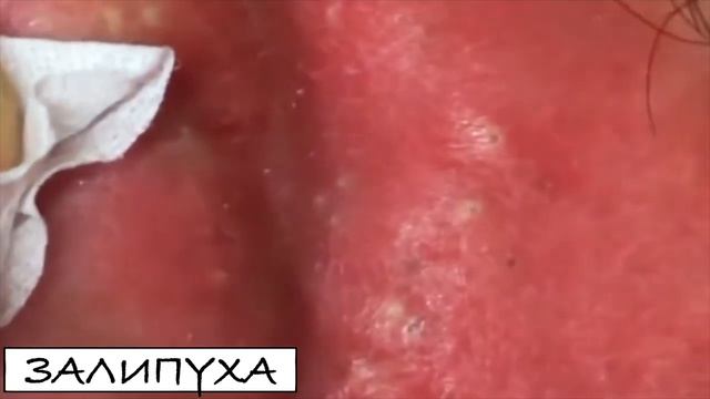 ПРЫЩИ ВЫДАВЛИВАНИЕ 😍 ВЫДАВЛИВАНИЕ ПРЫЩЕЙ 😍 ВЫДАВЛИВАНИЕ ЧЕРНЫХ ПРЫЩЕЙ #acne #прыщи #asmr смотреть онлайн